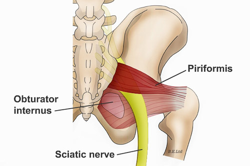 <h5>Sciatica</h5>